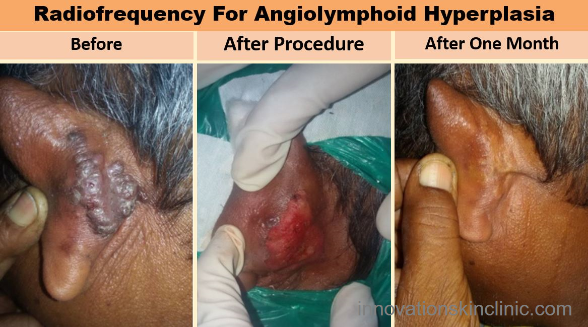 Surgeries For Benign Skin - Angiolymphoid Hyperplasia